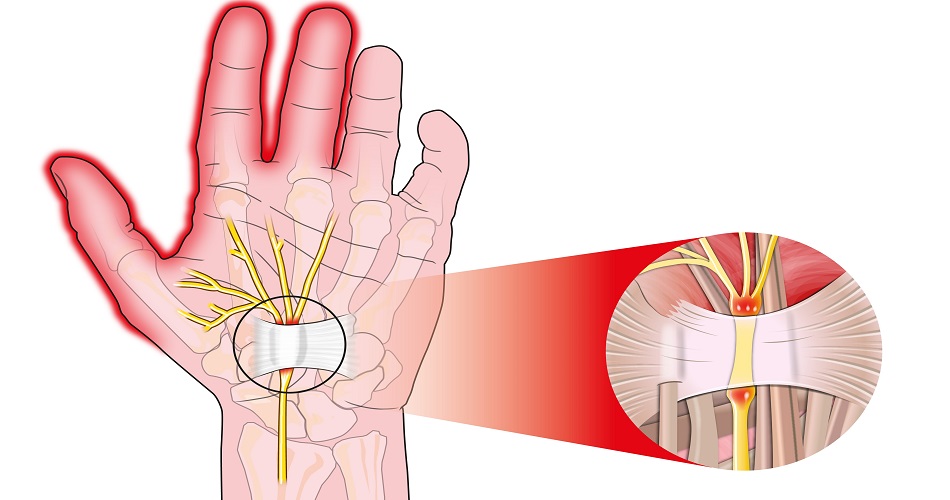 Воспаление сухожилия кисти руки: симптомы, лечение, профилактика